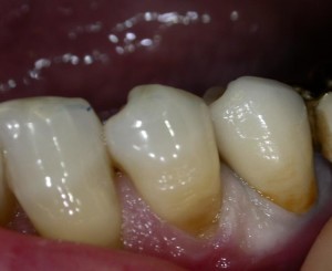 Cemento per denti in farmacia: come si usa